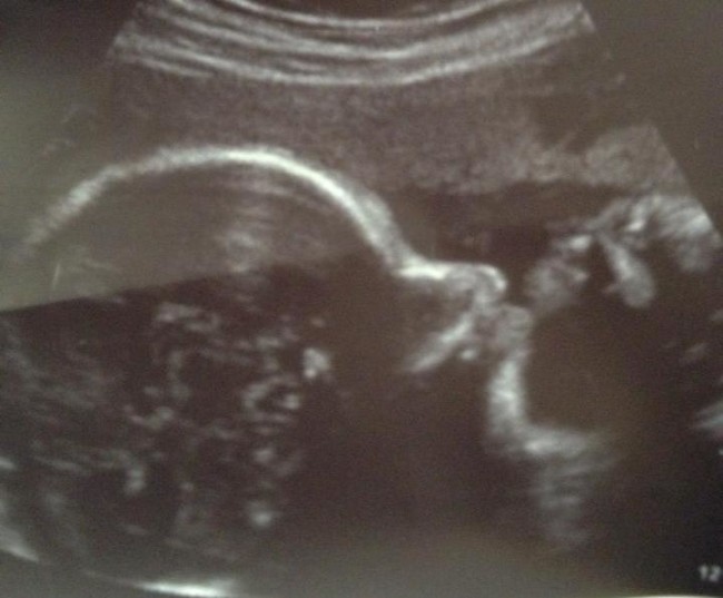 Baby Oliver at 28 weeks and five days