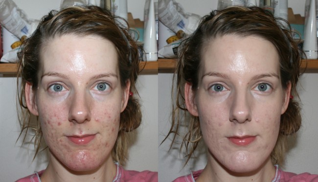 Oxygenetix Foundation before and after