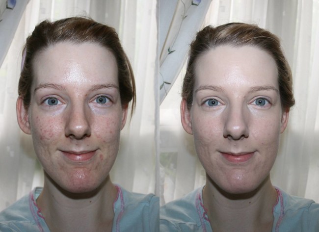 L’Oreal True Match Genius Foundation Before and After