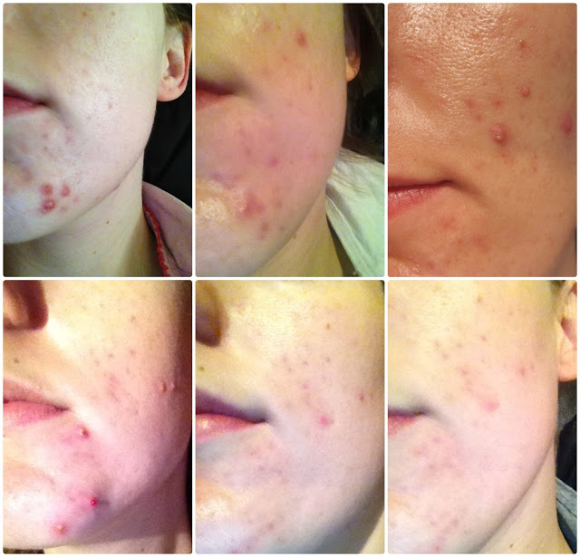 New Skin: Acne Treatment N-Lite Review and Picture Update