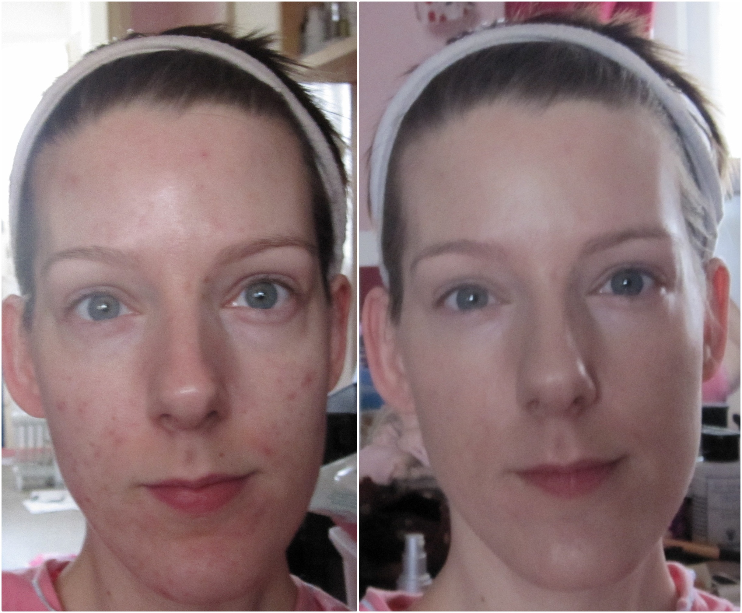 New Skin: Progress and my First Peel